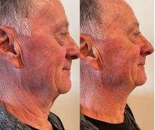 Load image into Gallery viewer, Before and after results of a customer doing Cryo Lifting Facials. Lifting Facials are a natural and non invasive facelift.