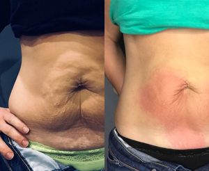 Before and after results of a customer doing a Cryo Lifting session. Cryo Lifting tightens, tones, and firms loose skin.