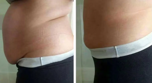 Before and after results of a female customer doing Cryo Slimming. Cryo Slimming eliminates fat instantly and permanently.