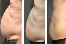 Load image into Gallery viewer, Before and after results of a male customer doing Cryo Slimming. Cryo Slimming eliminates fat instantly and permanently.