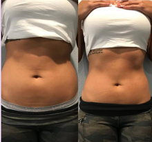 Load image into Gallery viewer, Before and after results of a female customer doing Cryo Slimming. Cryo Slimming eliminates fat instantly and permanently.