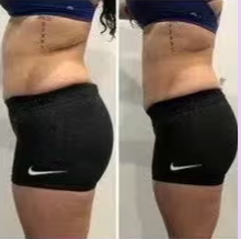 Load image into Gallery viewer, Before and after results of a female customer doing Cryo Slimming. Cryo Slimming eliminates fat instantly and permanently.