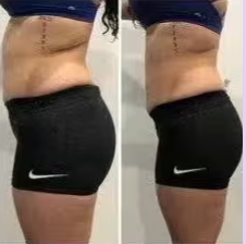 Before and after results of a female customer doing Cryo Slimming. Cryo Slimming eliminates fat instantly and permanently.