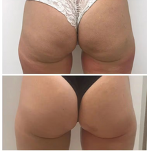 Load image into Gallery viewer, Before and after results of a customer doing Endospheres. Endospheres reduces cellulite, tightens, tones, and firms the skin.