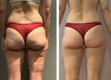 Load image into Gallery viewer, Before and after results of a customer doing Endospheres. Endospheres reduces cellulite, tightens, tones, and firms the skin.