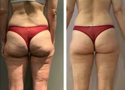 Before and after results of a customer doing Endospheres. Endospheres reduces cellulite, tightens, tones, and firms the skin.